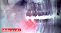 این نوع دندان درد علامت سرطان است