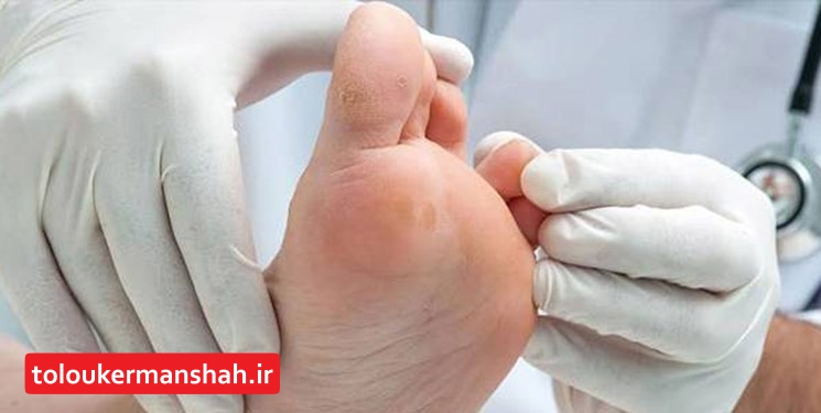 دستاورد متخصصان کرمانشاهی: ساخت پمادی گیاهی در درمان زخم پای دیابتی