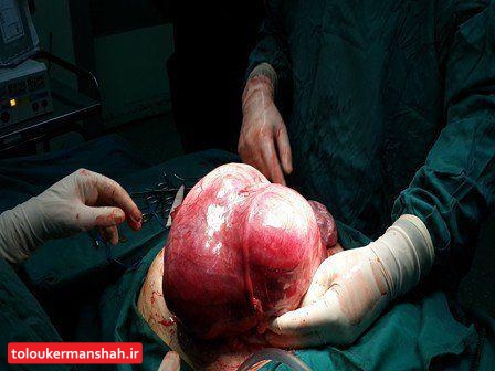 خارج کردن توده پنج کیلویی از شکم دختر ۱۳ ساله کرمانشاهی