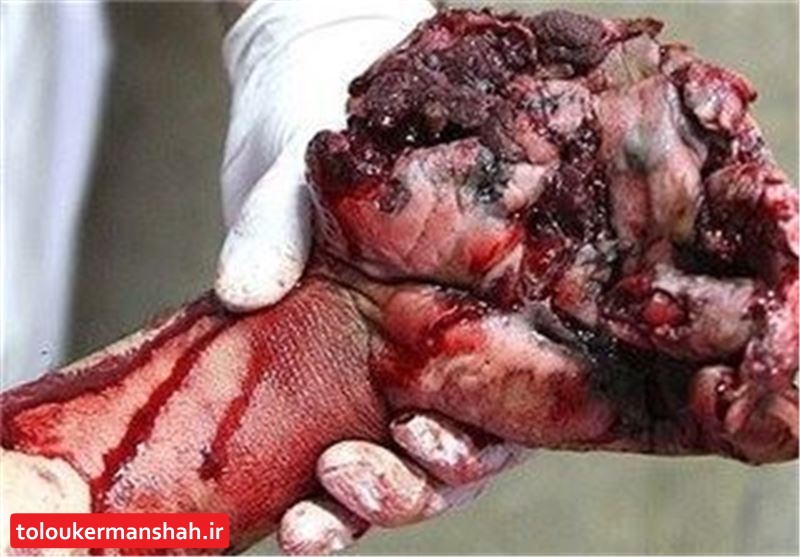 جوان ۳۰ ساله سنقری اولین مصدوم “چهارشنبه سوری” کرمانشاه/ قطع انگشت شست بر اثر انفجار ترقه