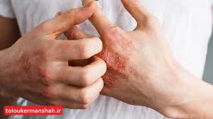 “الکل” با پوستِ دست چه میکند؟