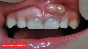 عفونت دندان را جدی بگیرید