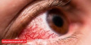 قرمزی چشم میتواند از علائم ابتلا به کرونا باشد
