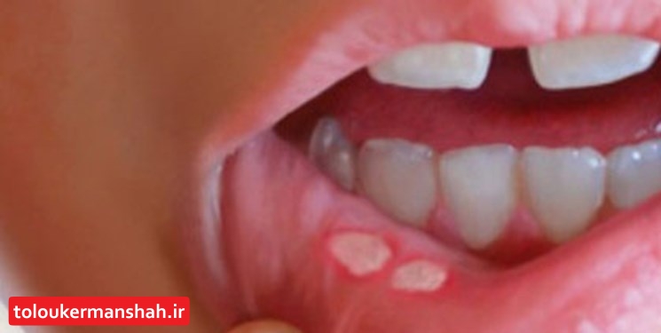 آفت دهان در زنان شایعتر است/ ابتلا به آفت می تواند ارثی باشد