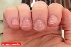 خطر کرونا از روی لکه های سفید ناخن