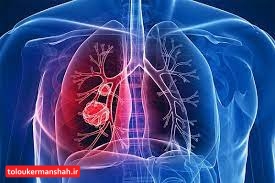 چگونه بفهمیم ریههای ما درگیر کرونا شده است؟
