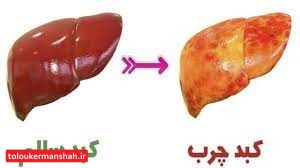 آنچه که درباره کبد چرب باید بدانیم