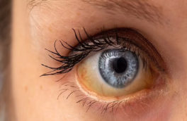 این سرطان خطرناک ابتدا ۴ هفته هشدار می دهد / هشدار بزرگ زردی چشم