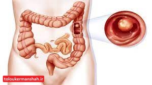 کاهش وزن خطر تبدیل پولیپ به سرطان روده را کم می کند