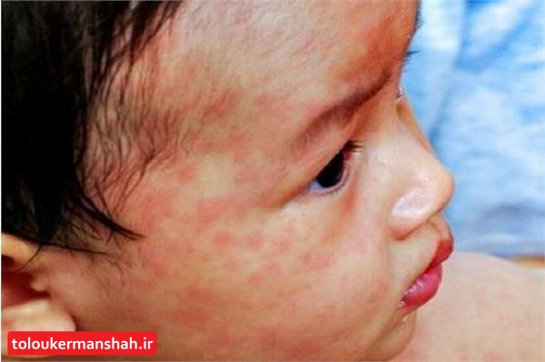 تاکنون موردی از ابتلا به سرخک در کرمانشاه گزارش نشده است