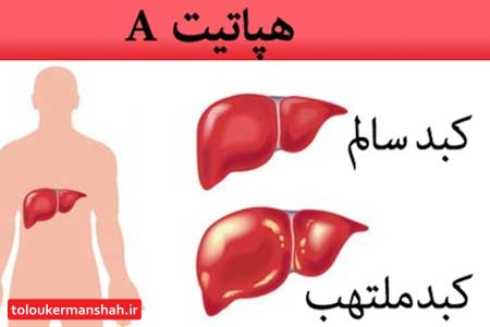 علایم باورنکردنی ابتلا به هپاتیت A