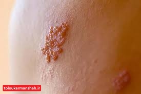 تاثیر تعامل ویروس های زونا و تبخال در شروع آلزایمر