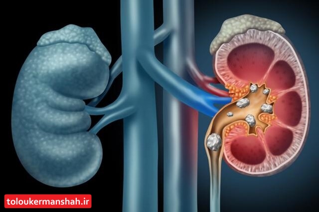 شیوع “سنگ کلیه” در کرمانشاه بالاست