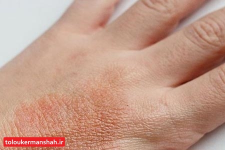 علائم اگزمای پوستی چیست؟