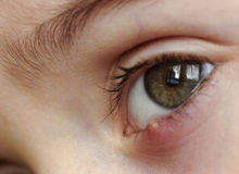 بیماری چشمی که کودکان را تهدید می‌کند