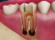 برای پیشگیری از التهاب ریشه دندان چه کنیم؟