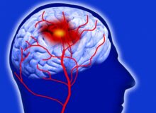 ۶ ساعت برای نجات از «سکته مغزی» فرصت است