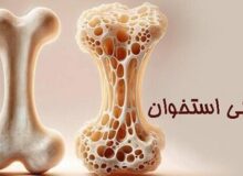 چطور جلوی «پوکی استخوان» را بگیریم؟