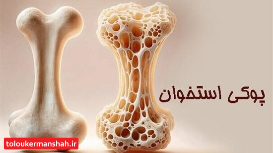 چطور جلوی «پوکی استخوان» را بگیریم؟
