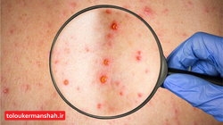 سرخک؛ مسری ترین بیماری عفونی کودکان/ واکسیناسیون را به تاخیر نیندازید