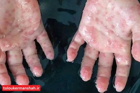 ماجرای مورد مشکوک به آبله میمون در ایران چه بود؟