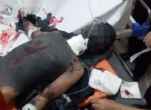 چهارشنبه سوری نیامده مصدوم داد!/ قطع ۲ دست نوجوان روانسری بر اثر انفجار “مواد محترقه”