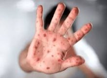 احتمال همه‌گیری آبله میمونی چقدر جدی است؟ 