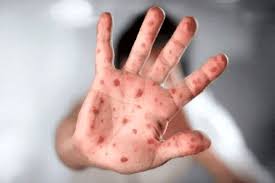 احتمال همهگیری آبله میمونی چقدر جدی است؟