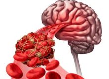 لخته خون این افراد را تهدید می کند