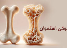 چطور با «پوکی استخوان» مقابله کنیم؟