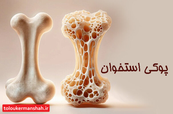 چطور با «پوکی استخوان» مقابله کنیم؟