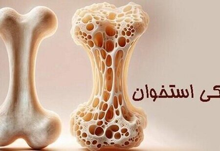 چطور جلوی «پوکی استخوان» را بگیریم؟